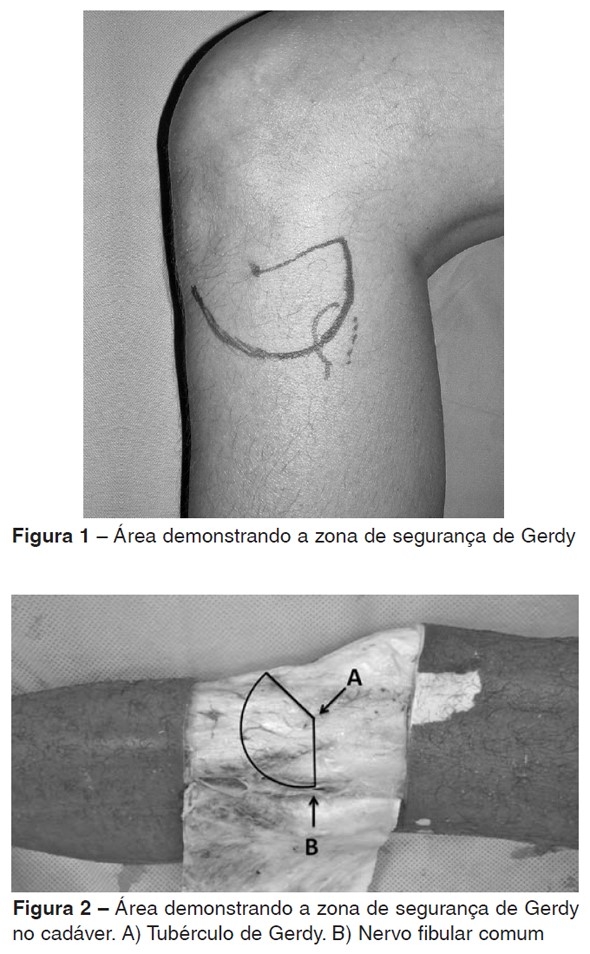 tubérculo de gerdy